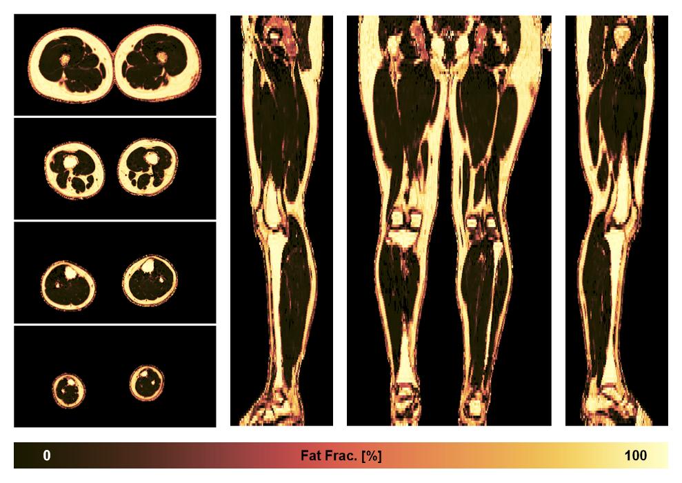 The fat fraction of the lower extremity obtained from the dixon reconstruction for muscle water fat quantification.